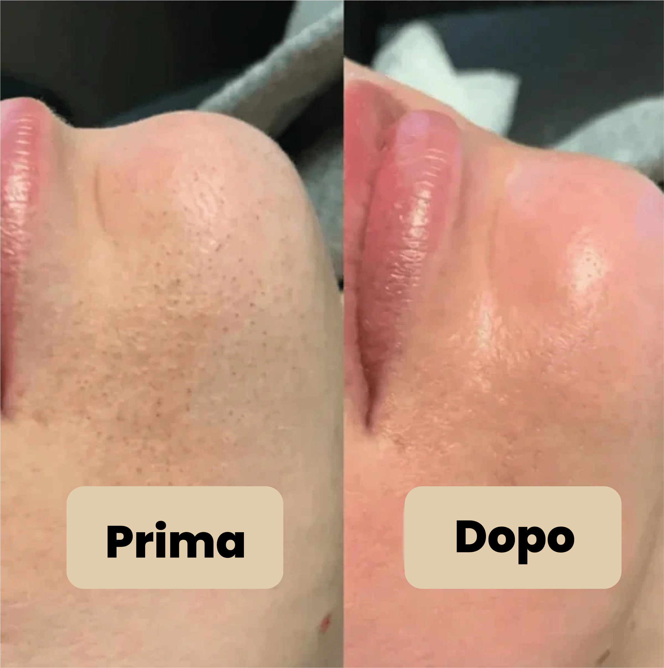Vélia® | Peel Shot Coreano – Elimina le impurità e sublima la pelle